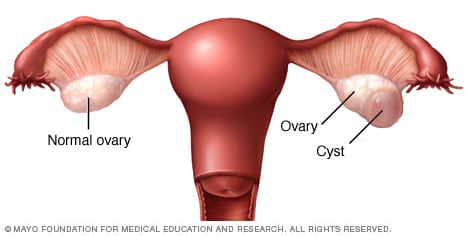 Corpus luteum cyst on ovary