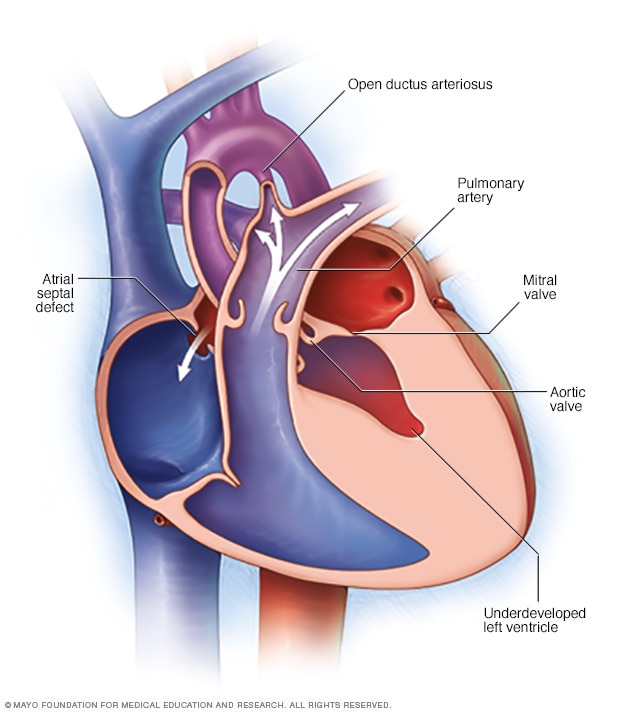 Hypoplastic left heart syndrome