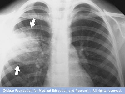 存在肺炎的肺部 X 线图像