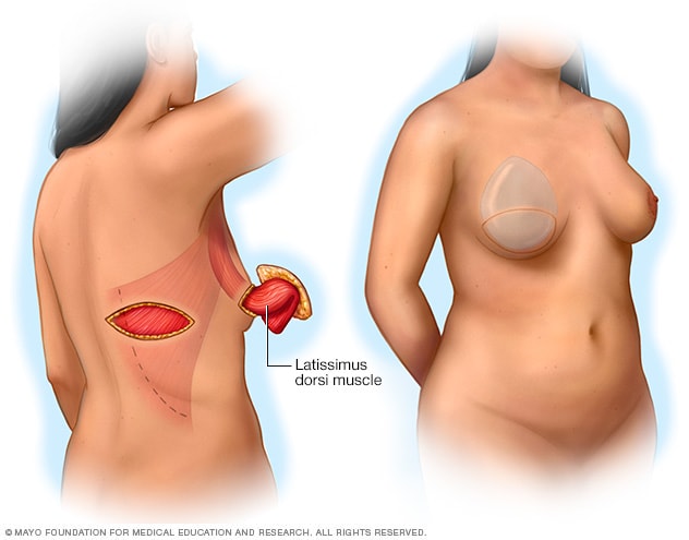 Ilustración del procedimiento de colgajo del músculo dorsal ancho pediculado 
