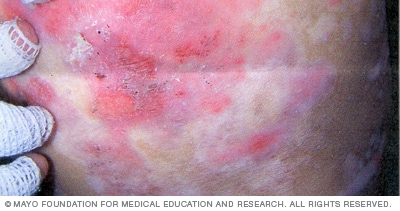 La epidermólisis bullosa distrófica evita que las capas de la piel se unan de la manera habitual.