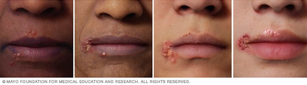 4 种不同肤色的人的唇疱疹。
