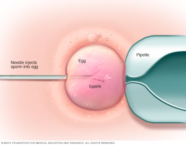 Ilustración que muestra la inyección intracitoplásmica de espermazoides