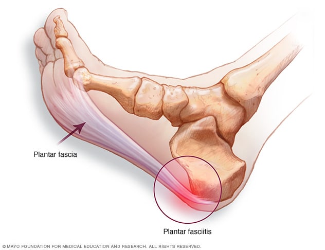 Fascia plantar y ubicación del dolor de talón 