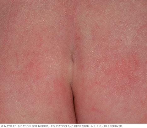 تجويف غير ضار في الجلد فوق الثنية الجلدية بين الأليتين.