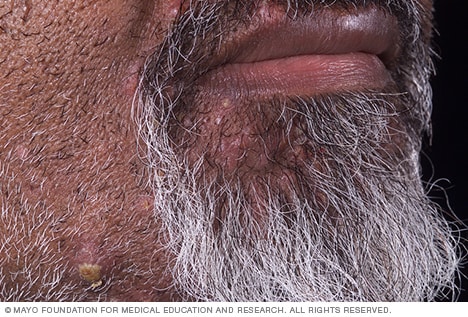 Seudofoliculitis de la barba
