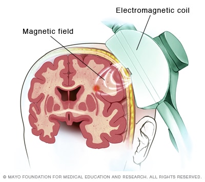 Estimulación magnética transcraneal repetitiva (EMTr)