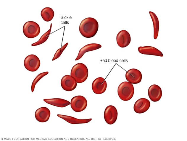 خلايا دم حمراء وخلايا منجلية