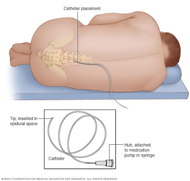 Colocación del catéter epidural