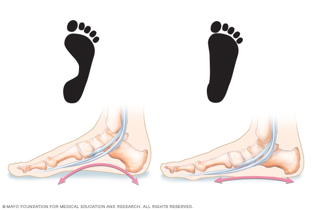Comparación de la huella de un pie normal y uno plano