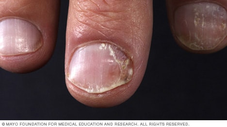 Psoriasis de uñas