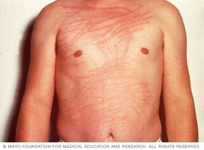 خدش بالجلد يُظهر خطوطًا بارزة أو بقعًا لشخص مصاب بكتوبية الجلد.