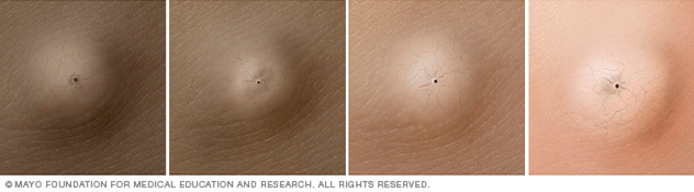 表皮样囊肿在四种不同肤色上的显示。
