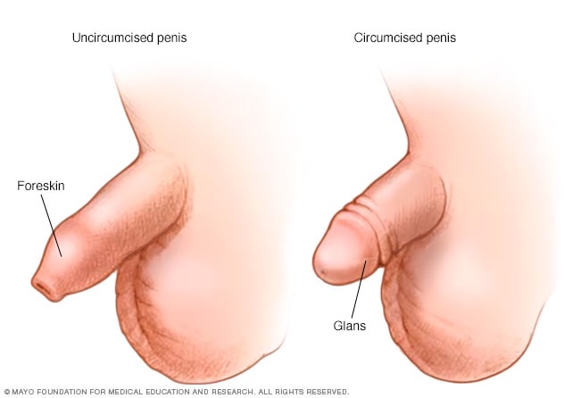 El pene antes y después de la circuncisión 
