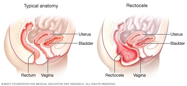 Typical anatomy and posterior vaginal prolapse (rectocele)