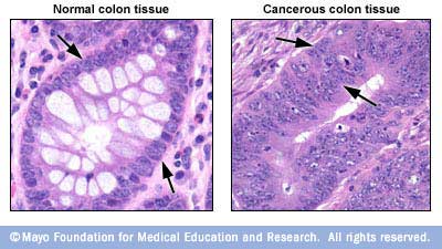 صورة لنسيج قولوني طبيعي إلى جانب نسيج القولون السرطاني 