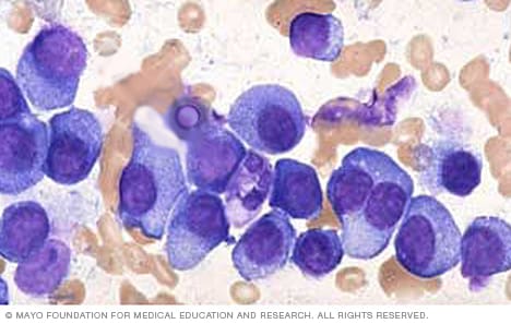 骨髓瘤细胞的图片 