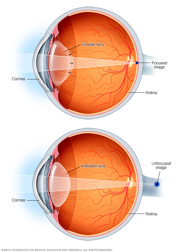 Globos oculares con punto de enfoque sin presbicia (arriba) y con presbicia (abajo)