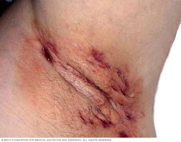 化脓性汗腺炎常见于腋窝。