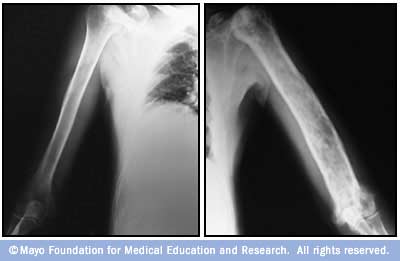 Image showing Paget's disease of bone 
