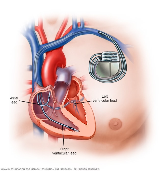 جهاز تنظيم ضربات القلب