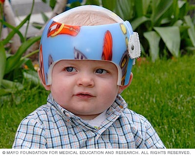 戴着模塑头盔的婴儿