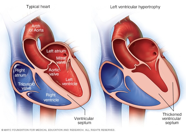 Hipertrofia ventricular izquierda