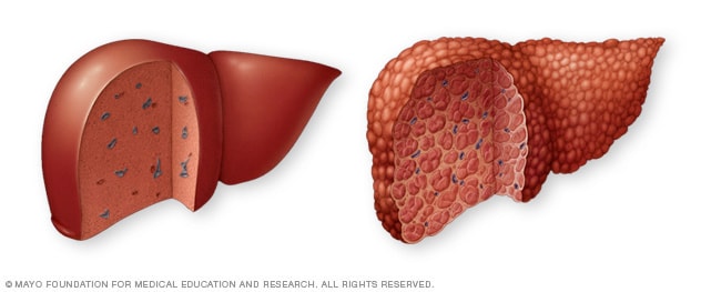 Un hígado sano comparado con un hígado con cirrosis