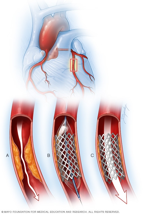 冠状动脉支架