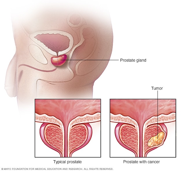 典型前列腺与患癌前列腺的对比图