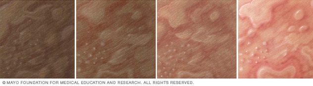 荨麻疹在四种不同肤色上的显示。
