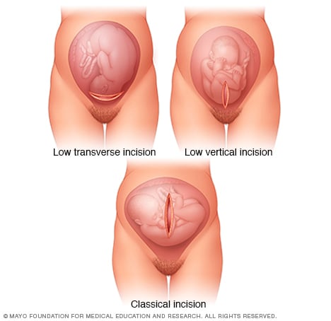 Incisiones uterinas realizadas en cesáreas