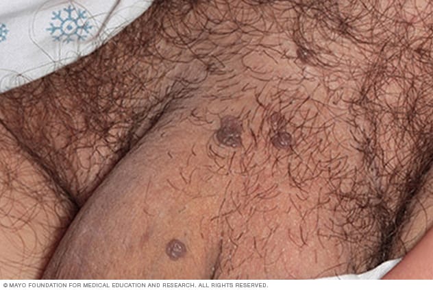 一位男性患者身上的生殖器疣