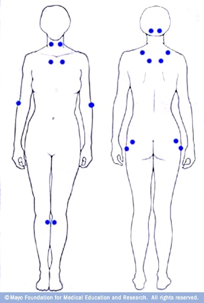 Ilustración de los 18 puntos sensibles asociados con la fibromialgia 
