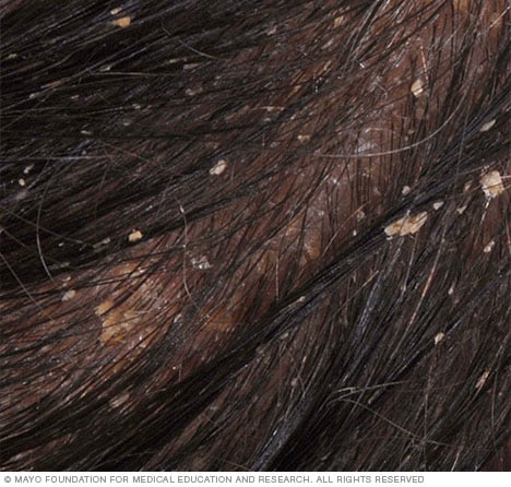 Dermatitis seborreica del cuero cabelludo 