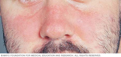 Dermatitis seborreica en la cara