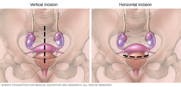 شقوق البطن العمودية والأفقية لجراحة استئصال الرحم