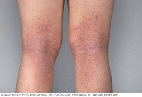 Dermatitis atópica en las piernas