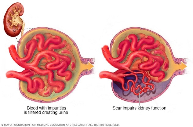 肾脏中的肾小球显示了典型肾小球和疤痕肾小球