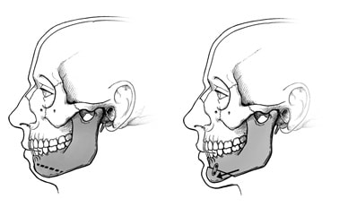Ilustración de una cirugía de mentón que muestra cómo la mandíbula se divide y desplaza hacia adelante.