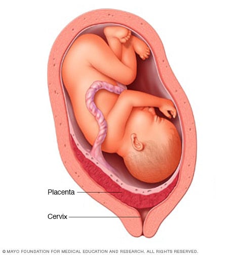 Ubicación de la placenta en la placenta previa
