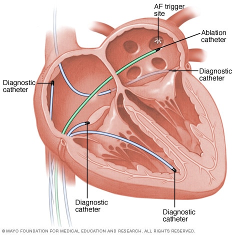 A heart during catheter ablation