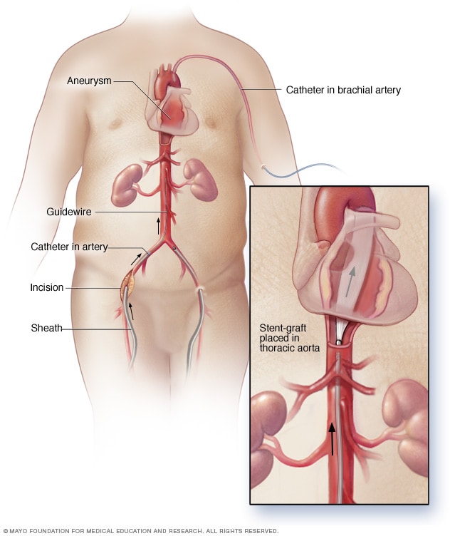 Reparación endovascular de un aneurisma de la aorta torácica