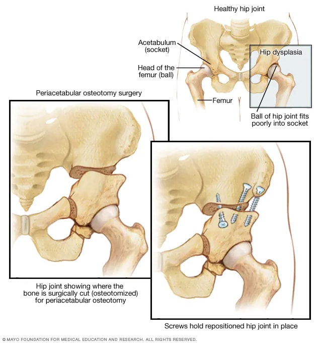 Osteotomía periacetabular