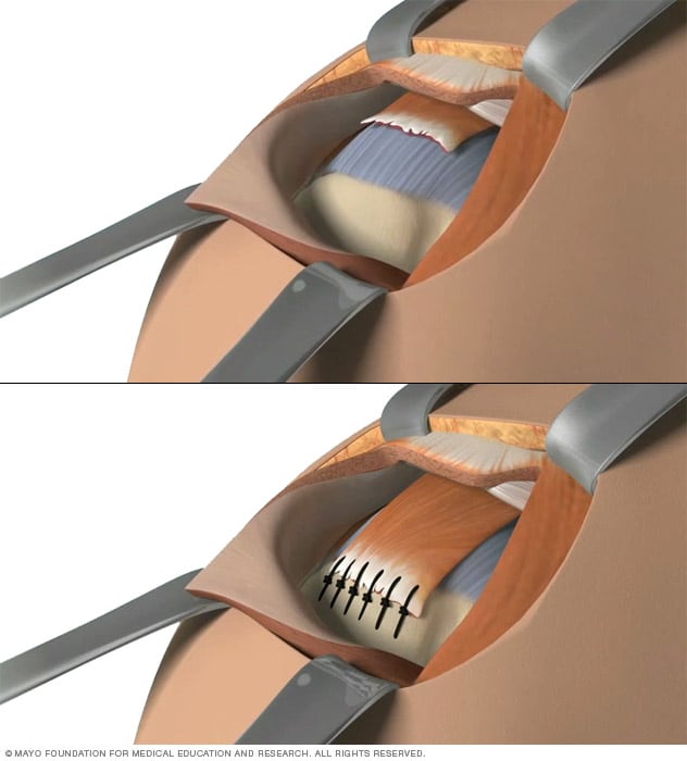 Ilustración en la que se observa reparación abierta de manguito rotador