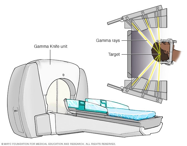 تسليط قدر من الإشعاع على الرأس باستخدام أشعة غاما.