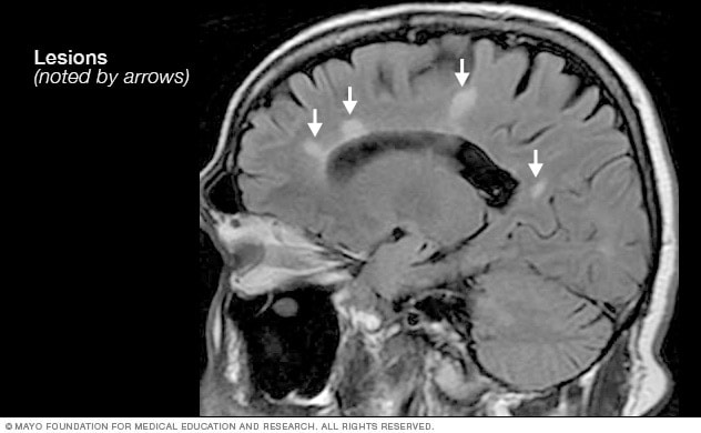 Lesiones de esclerosis múltiple en el cerebro