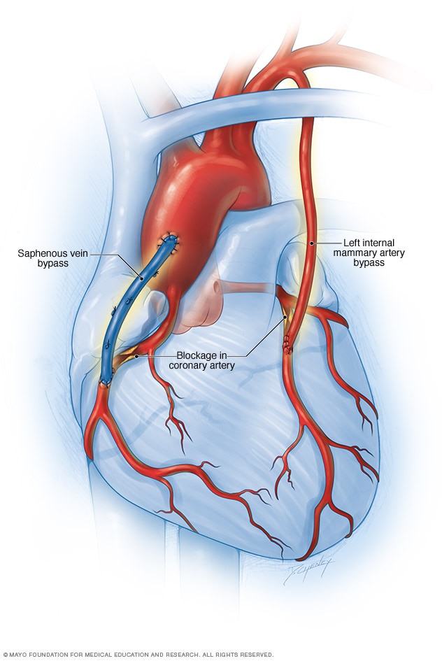 Cirugía de baipás de la arteria coronaria