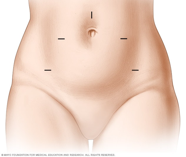 机器人子宫切除术的切口位置