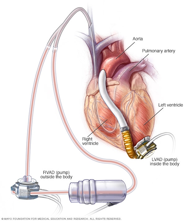 Dispositivo de asistencia ventricular derecha e izquierda